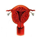 endometryoz